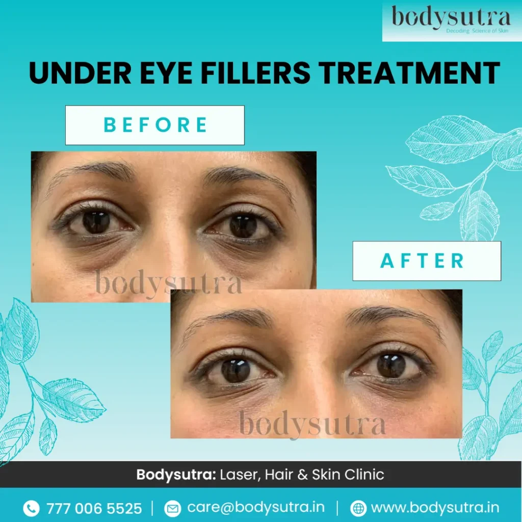 Under-Eye-Fillers-Treatment-in-Pimpri-Chinchwad.webp